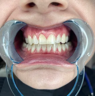 Avaliação de manchas dentárias