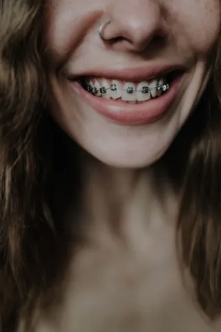Sorriso após tratamento ortodôntico
